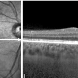 choroidal thickness in women